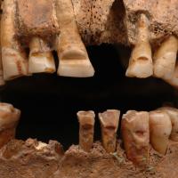 Suède - Dents limées du squelette masculin de la tombe 25 à Slite, district d'Othem, Gotland - Photo: SHM/ Lisa Hartzell